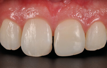 IPS Empress Direct | Dental Composites | Ivoclar US